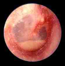 Acute otitis media