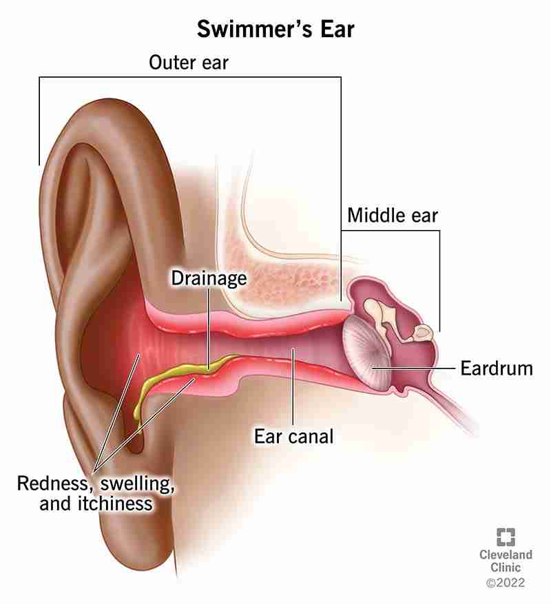 Otitis externa